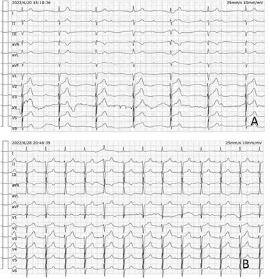 Case Report: Multimodality imaging of a bronchogenic cyst in the interatrial septum